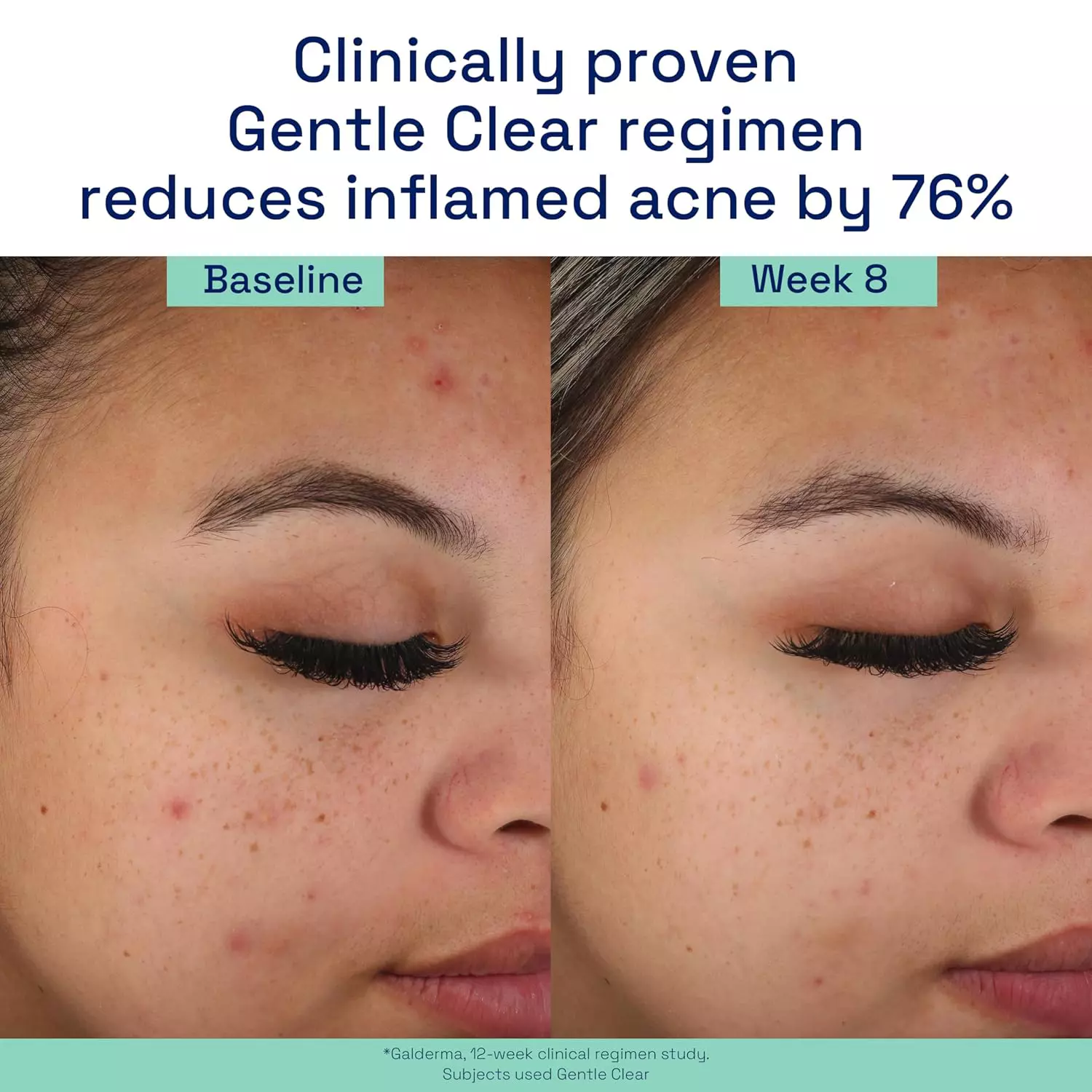 Cetaphil Gentle Clear Mattifying Acne Moisturizer-89ml thumbnail 8